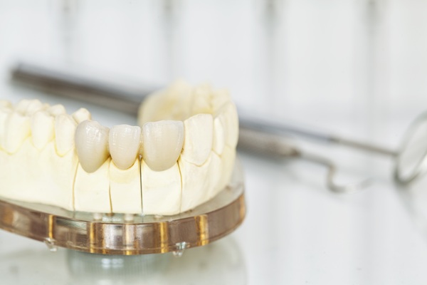 Dental Bridges: A Lasting Solution For Missing Teeth