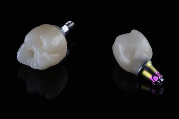 Dental Implant Crown Placement FAQs